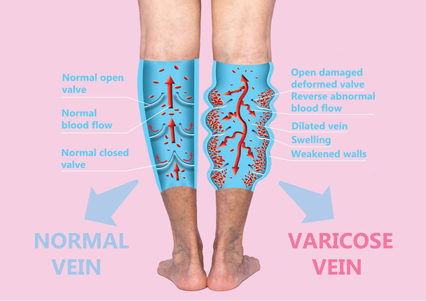 Варикозне розширення вен на жіночих ногах. Структура нормальних і варикозних вен
. - Фото, зображення