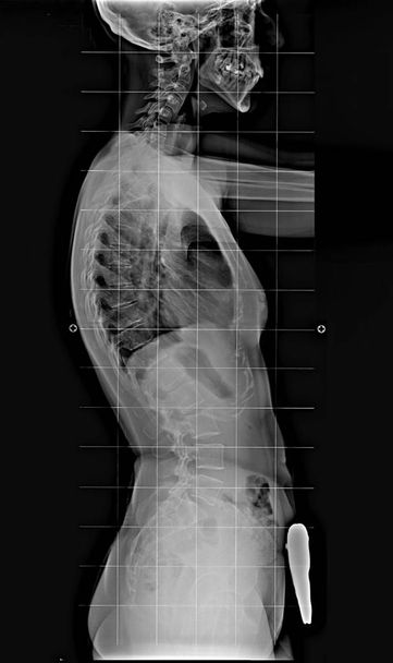 İnsan vücudundan leğen kemiği, tam spinal, kifoz ve lordoz, yan görünüm göğüs X-Ray - Fotoğraf, Görsel