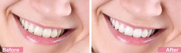 Улыбающаяся молодая женщина до и после процедуры отбеливания зубов, крупный план
 - Фото, изображение