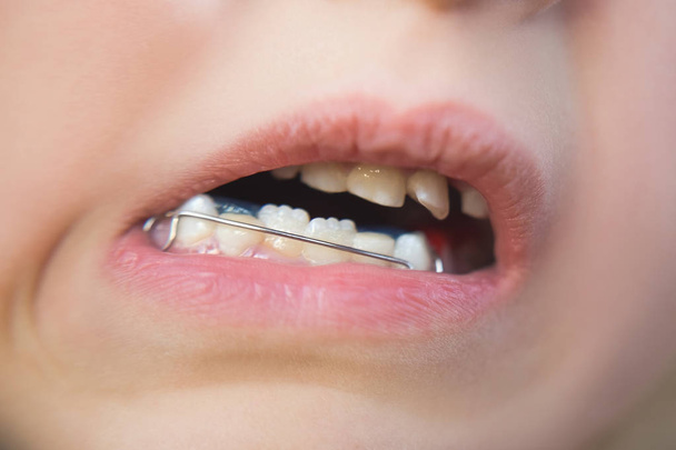Photo de la bouche d'une petite fille avec un appareil orthodontique et des dents tordues
 - Photo, image