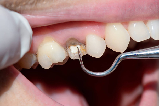 Diş hekimi diş hekimi dişlerde bir hastanın incelenmesi. - Fotoğraf, Görsel