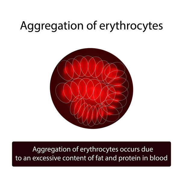 Agregación de glóbulos rojos. Eritrocitos. Ilustración vectorial sobre fondo aislado
 - Vector, imagen