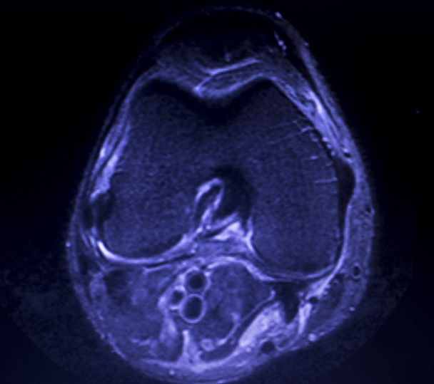 Obrazowanie rezonansu magnetycznego Mri kolana tylnego rogu łąkotki przyśrodkowej łza scantest wyniki. - Zdjęcie, obraz