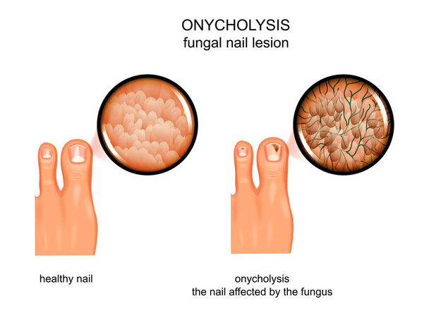 ilustración vectorial de lesión micótica en las uñas. infección, onicolisis
 - Vector, imagen