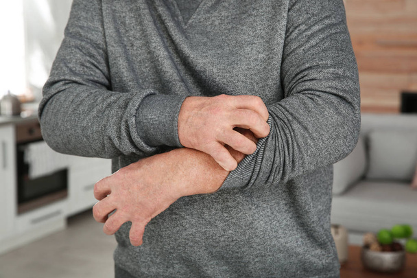 Mature man scratching arm at home, closeup. Annoying itch - Foto, Imagem