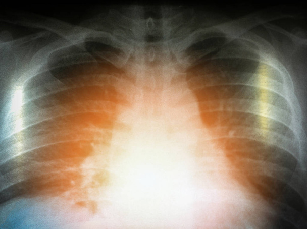 rintakehän röntgenfilmi näyttää ihmisen lääketieteellinen diagnoosi
 - Valokuva, kuva