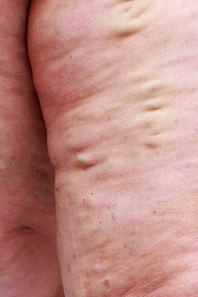 de ziekte spataderen op een benen - Foto, afbeelding