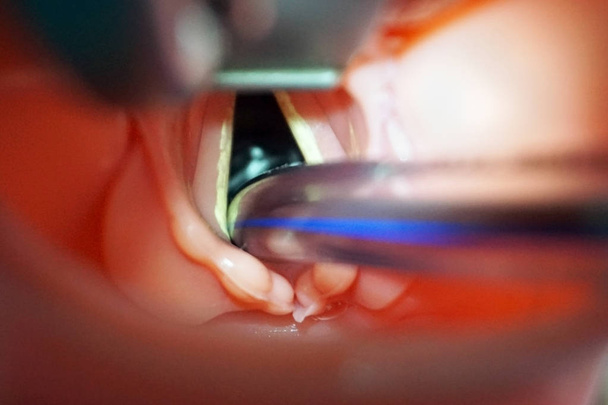 Intubationsschlauch in den Atemwegen. Durchführung einer orotrachealen Intubation an einer simulierten Schaufensterpuppe während des medizinischen Trainings zur Kontrolle der Atemwege. Vollnarkose. Medizinische Manipulation. - Foto, Bild