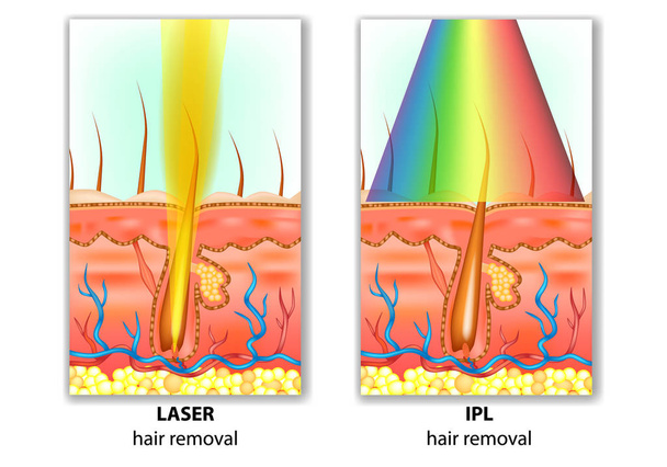 IPL (έντονο παλόμενο φως) και Laser αποτρίχωση. Διαφορές αφαίρεσης τρίχας - Διάνυσμα, εικόνα