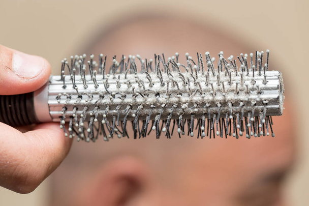 dandruff on the comb. close - Φωτογραφία, εικόνα