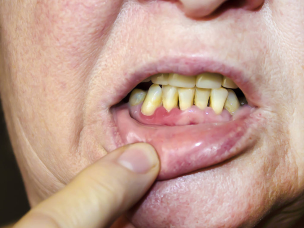 Parodontitis het inflammatoire proces op het gebied van gom. Blootstelling van de nek van de tanden. De arts onderzoekt de mondholte. Voorafgaand onderzoek door een tandarts. - Foto, afbeelding
