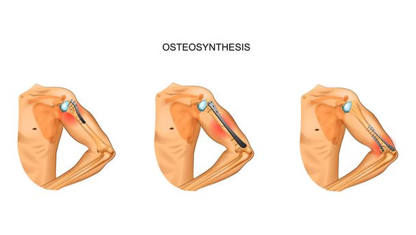 vector illustration of osteosynthesis of the humerus - Vector, Image