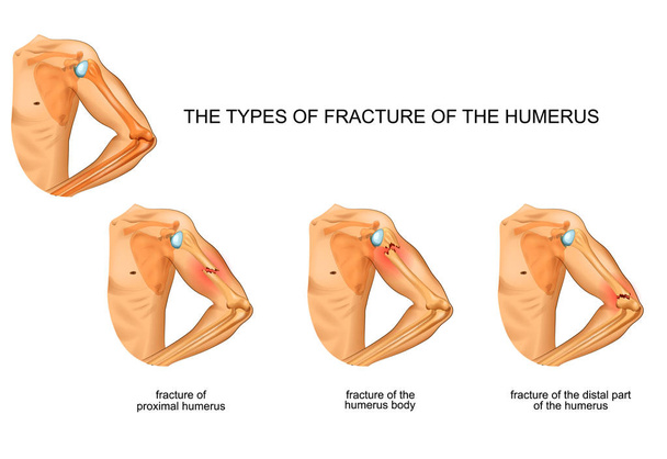 vector illustration of humerus fracture, trauma, surgery - Vector, Image
