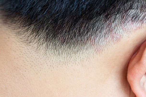 Zavřený kožního onemocnění (tinea) na hlavu asijských člověka (dermatitida) - Fotografie, Obrázek