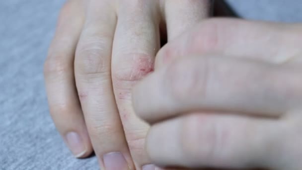 Mano de niña con eczema y psoriasis picazón fuerte
 - Imágenes, Vídeo