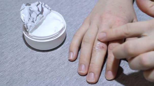 Ragazza strofina la mano crema con eczema e psoriasi
 - Filmati, video