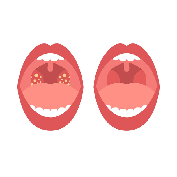 tonsillitis vector color icon - Vettoriali, immagini