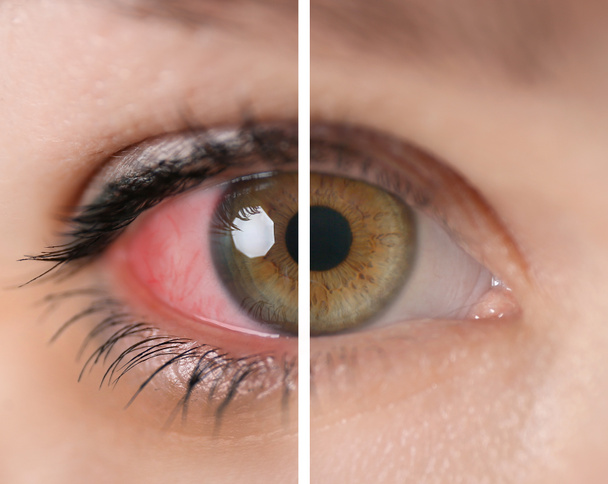 Young woman with and without eye redness, closeup - Photo, Image