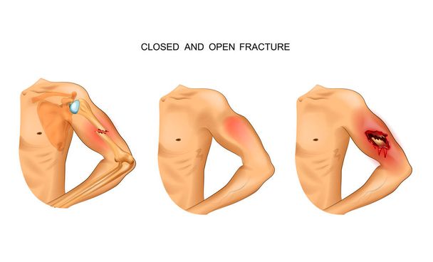 vector illustration of open and closed fracture - Vector, Image