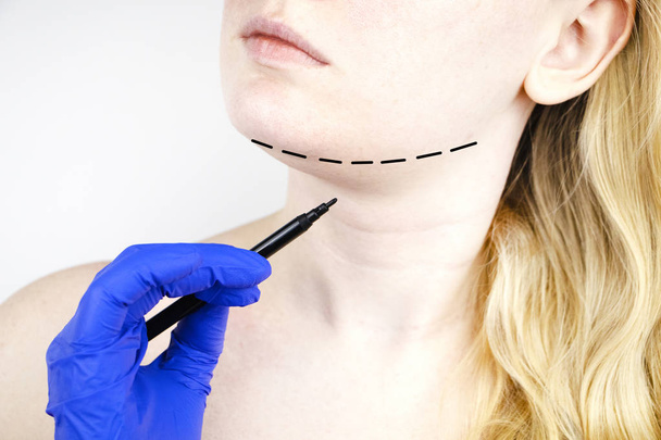 Mentoplastia: barbilla de plástico. Paciente antes de cirugía de barbilla y cuello. Cirujano plástico asesora
 - Foto, imagen