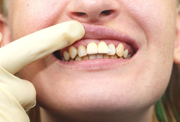 Primer plano de los implantes dentales sin éxito implantados
 - Foto, imagen