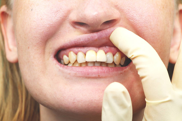 Close-up de implantes dentários implantados sem sucesso
 - Foto, Imagem