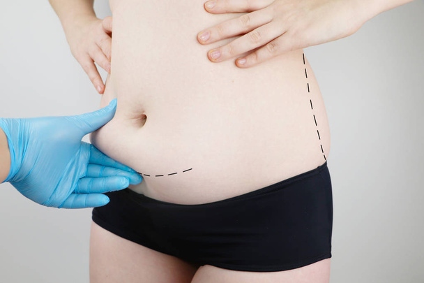Abdominoplastia y torsoplastía: liposucción abdominal y extirpación del delantal. El paciente en la recepción en el cirujano plástico
 - Foto, imagen