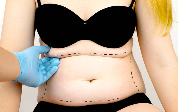 1,823 Abdominoplasty Body Images, Stock Photos, 3D objects