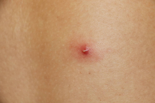 Close up of a pimple on the back - Photo, Image