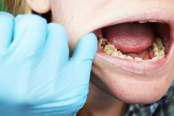 Caries profunda, canales abiertos, canales de limpieza. Paciente en estomatología al ingreso, tratamiento de periodontitis
 - Foto, imagen