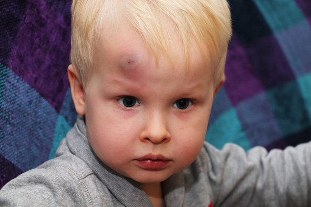 A big bruise on the forehead of a little boy - Fotografie, Obrázek