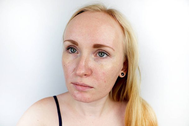 Oily and problem skin. Portrait of a blonde girl with acne, oily skin and pigmentation - Foto, imagen