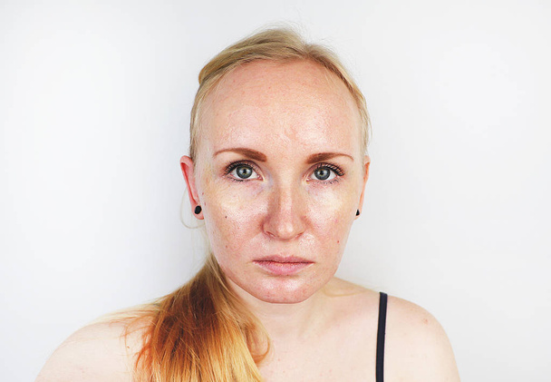 Vette en probleemhuid. Portret van een blond meisje met acne, vette huid en pigmentatie - Foto, afbeelding