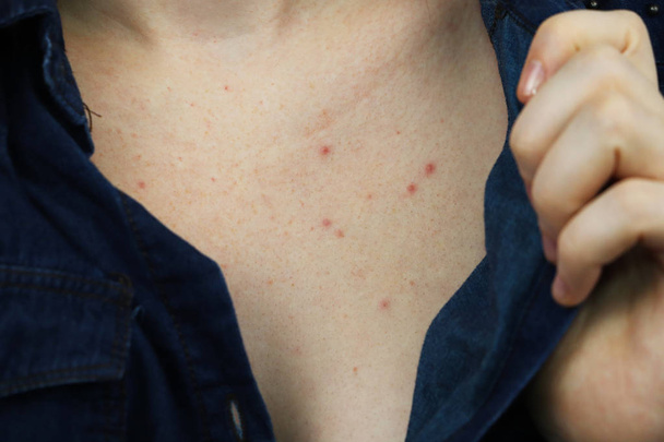 Allergiekonzept. junge Frau mit Pickeln auf der Brust, Nahaufnahme - Foto, Bild
