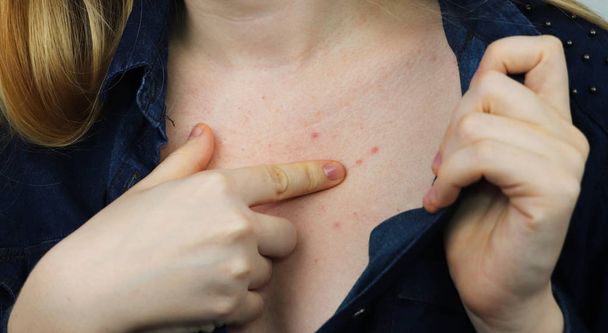 Pojęcie alergii. Młoda kobieta z pryszczami na klatce piersiowej, zbliżenie - Zdjęcie, obraz
