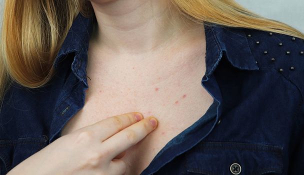 Концепція алергії. Молода жінка з прищами на грудях, крупним планом
 - Фото, зображення