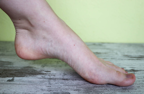 Varices sur les jambes d'une femme
 - Photo, image