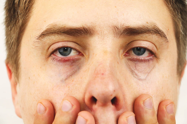 Bindehautentzündung, müde Augen, rote Augen, Augenkrankheiten - Foto, Bild