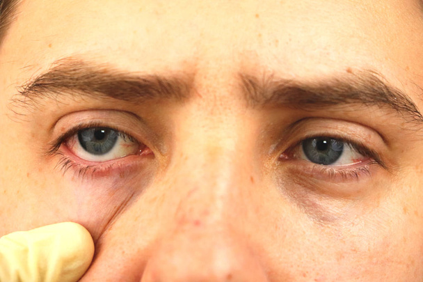 Bindehautentzündung, müde Augen, rote Augen, Augenkrankheiten - Foto, Bild