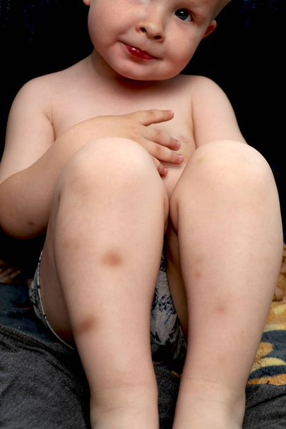 Çocuğun bacaklarda morluklar - Fotoğraf, Görsel