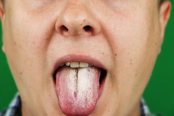 Man met halitosis voor Candida albicans op tong - Foto, afbeelding