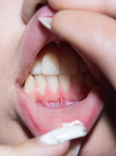 Зубы во рту, девушка открыла губы и показывает белые зубы после отбеливания зубов у стоматолога. Модная здоровая модель и свежее дыхание, восхитительный поцелуй от красоты. Маникюр и белая улыбка
 - Фото, изображение