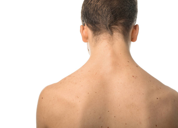 Teenager with acne problem on white background - Foto, Imagen