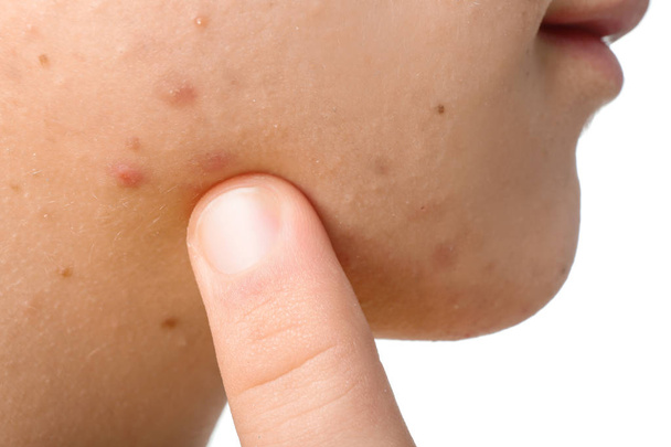 Adolescente com problema de acne, close-up
 - Foto, Imagem