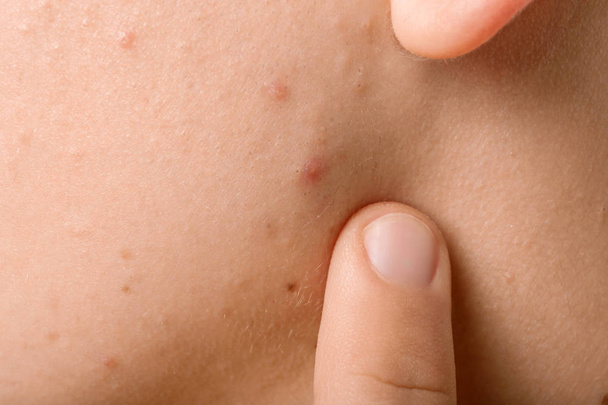 Teenager with acne problem, closeup - Фото, изображение