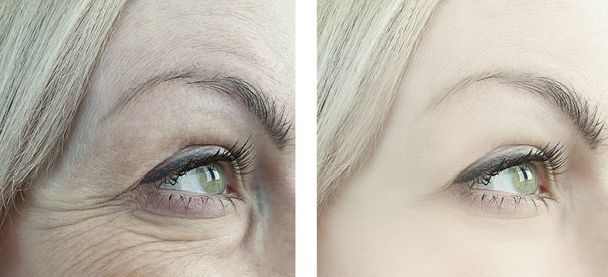 ženské oko vrásky před a po ošetření - Fotografie, Obrázek
