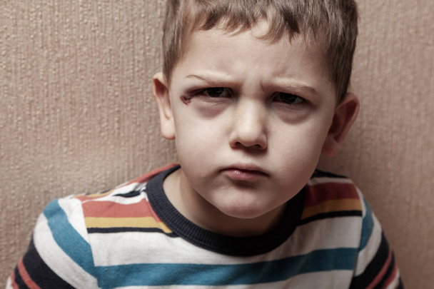 Aile içi şiddet. Çocuk istismarı. Çürükler yakınındaki gözleri ile üzgün çocuk - Fotoğraf, Görsel