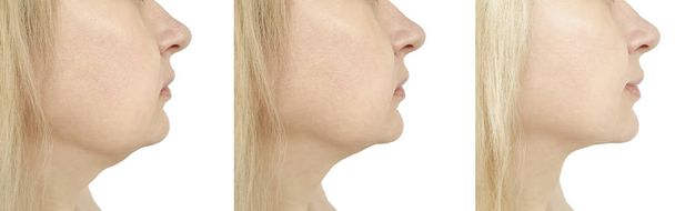 женщина подбородок до и после процедуры, ретушь
 - Фото, изображение