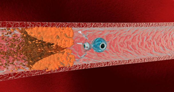 The nanorobot removed cholesterol plaques. Concept of the future. 3D render - Photo, Image