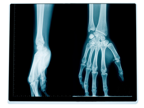 Radiografia de mãos e punhos
 - Foto, Imagem